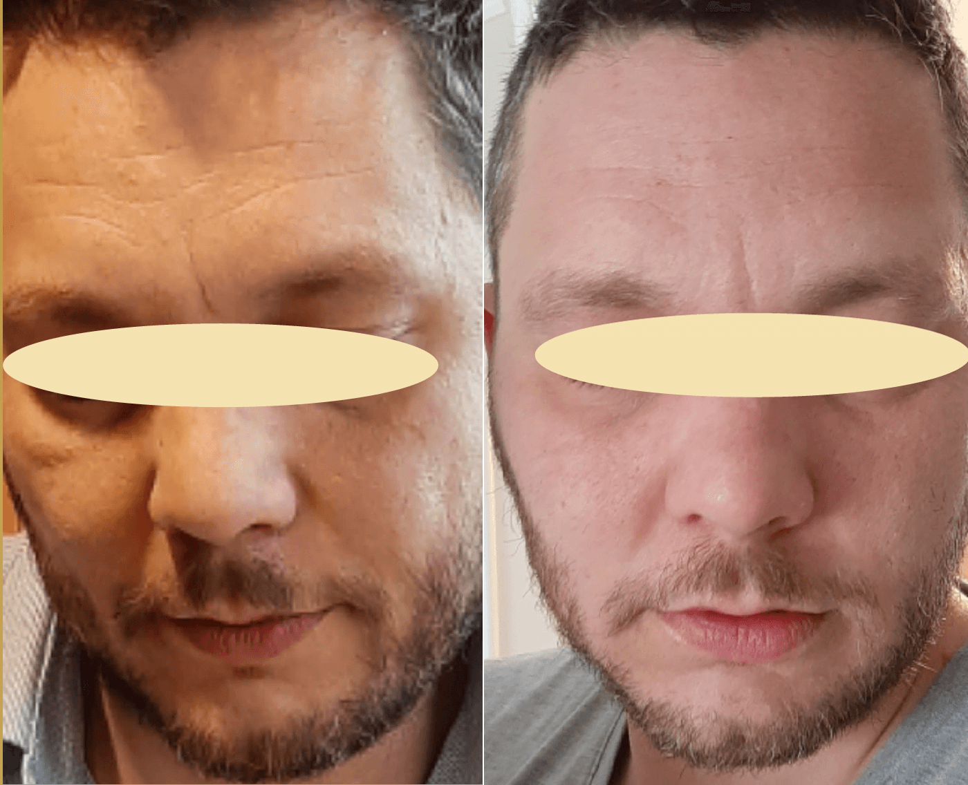 Example of Exosomes effect