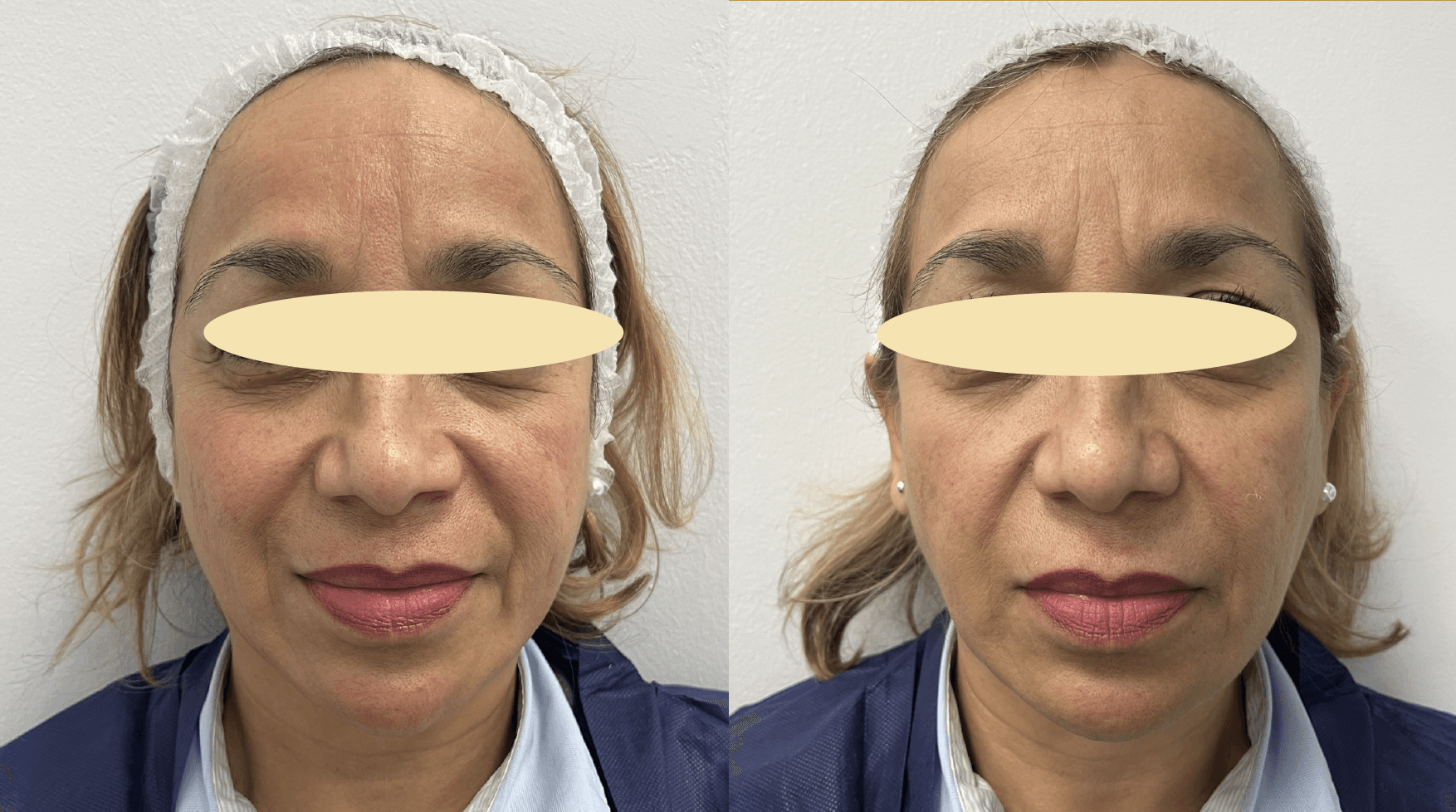 Example of Exosomes effect