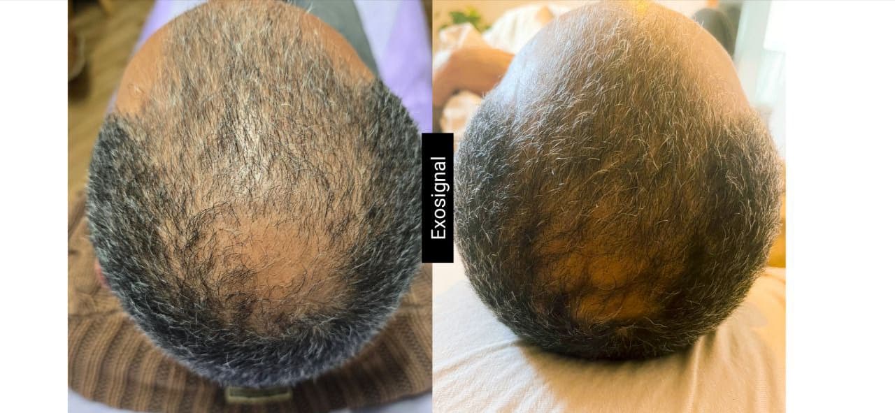 Example of Exosomes effect