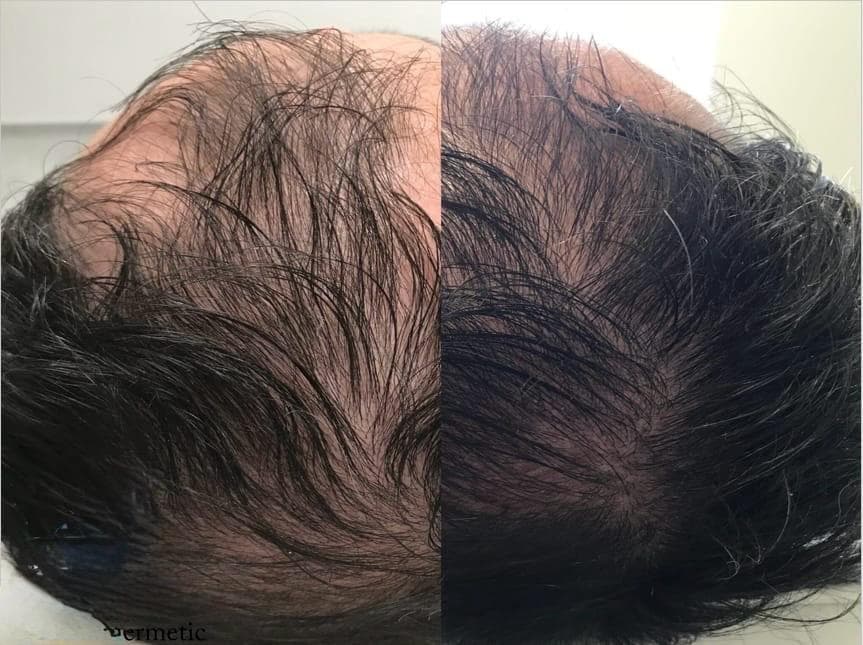 Example of Exosomes effect