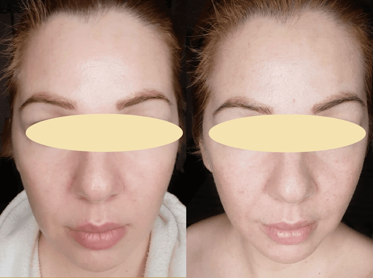 Example of Exosomes effect