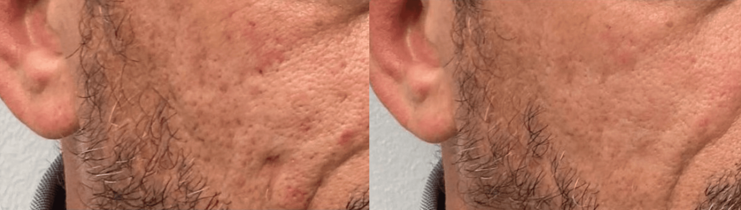 Example of Exosomes effect