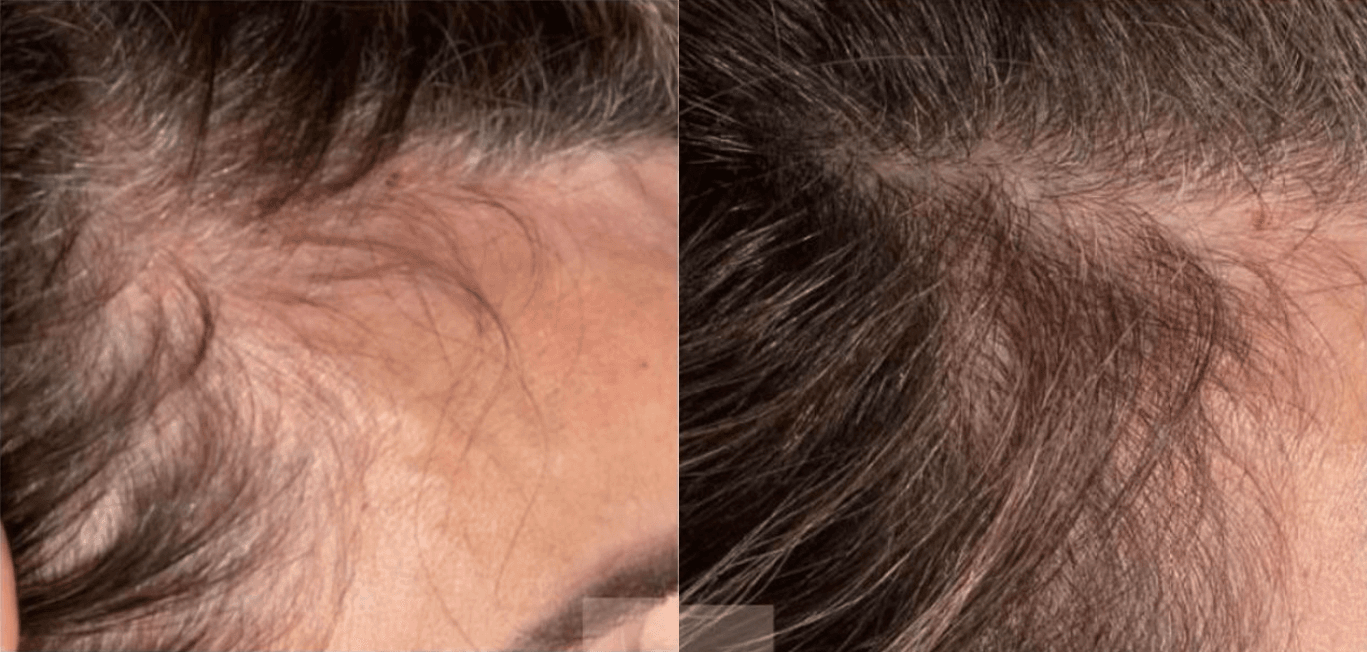 Example of Exosomes effect