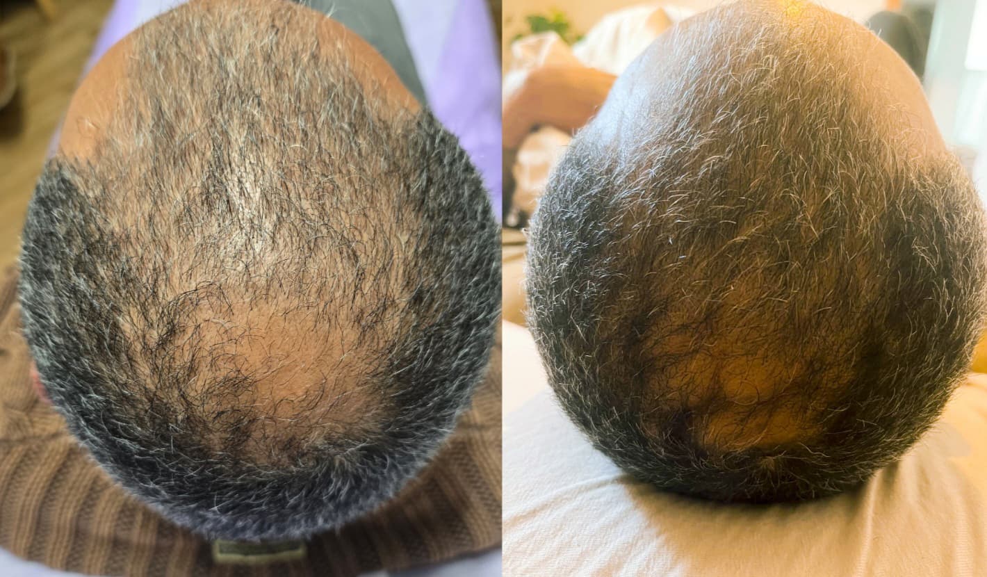 Example of Exosomes effect