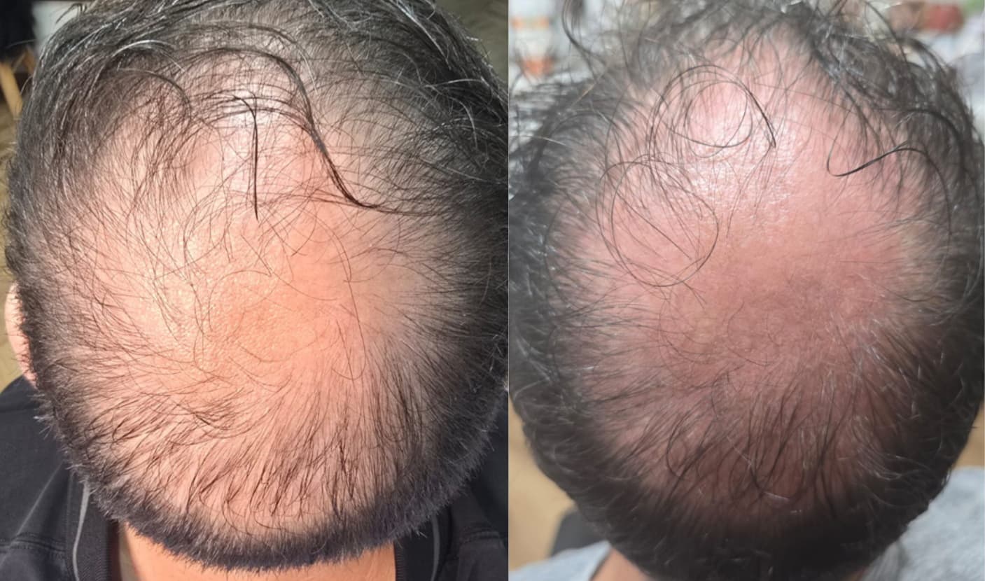 Example of Exosomes effect