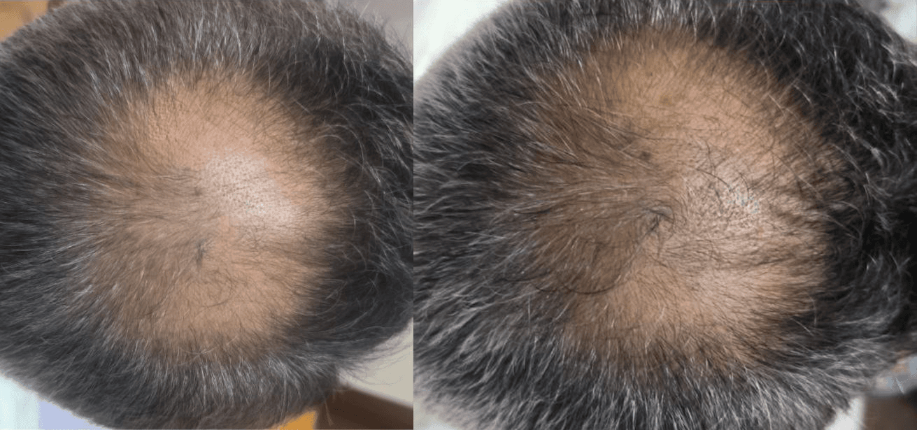 Example of Exosomes effect