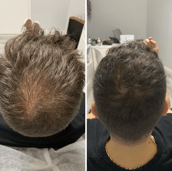 Example of Exosomes effect