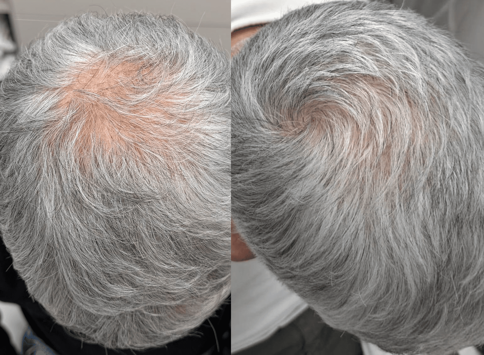 Example of Exosomes effect