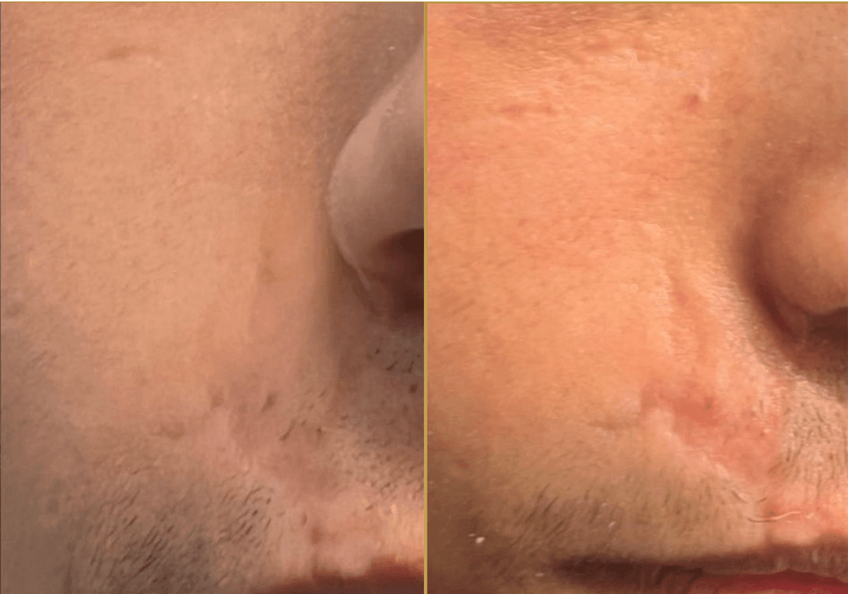 Example of Exosomes effect