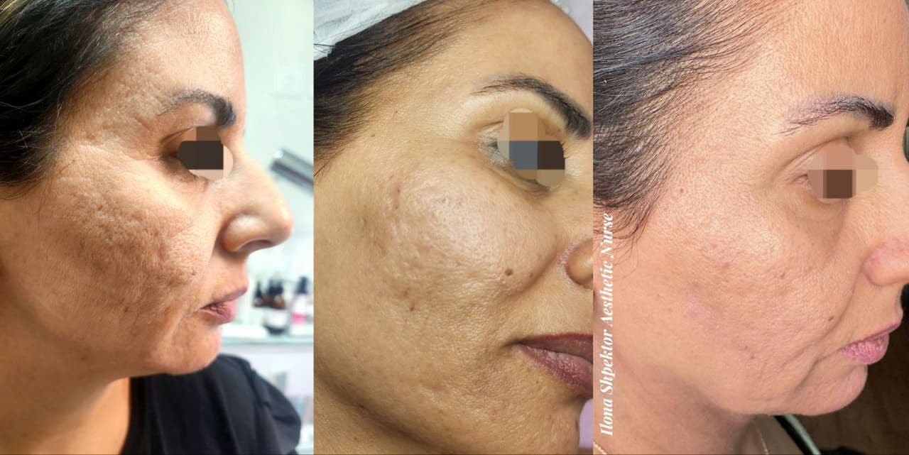 Example of Exosomes effect