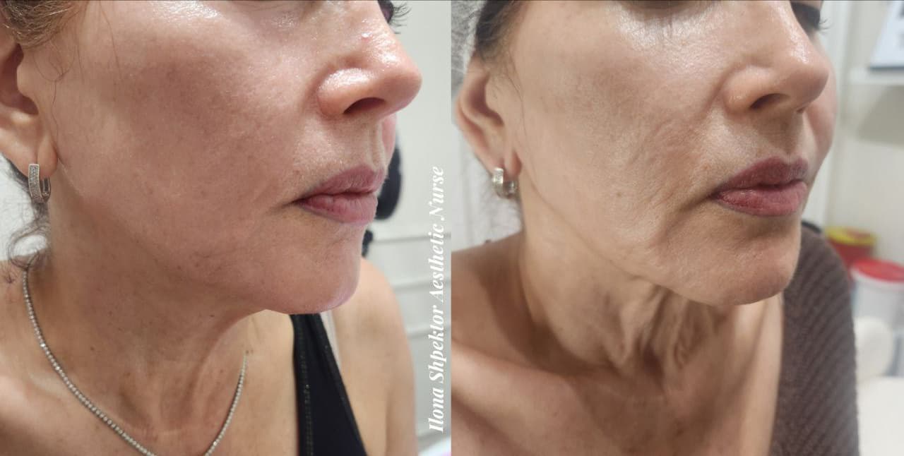 Example of Exosomes effect